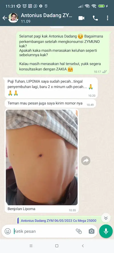 lipoma.webp